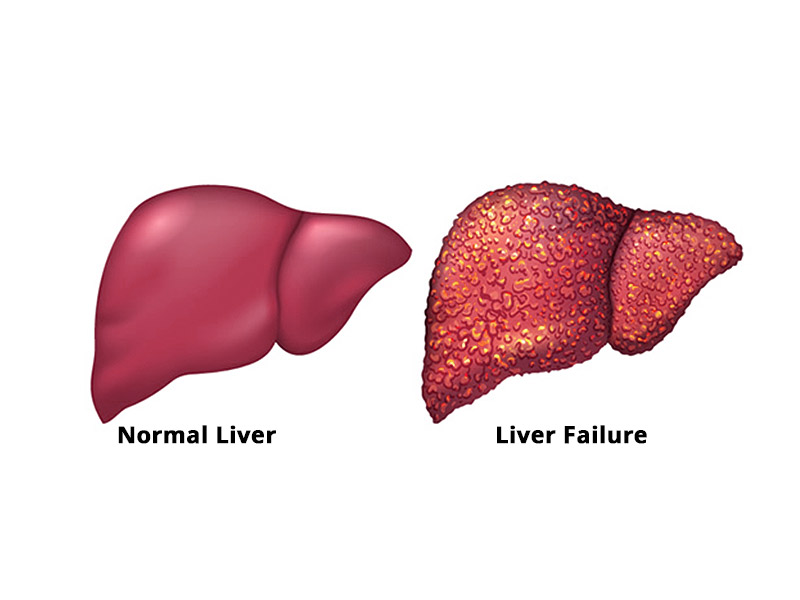 Acute liver failure